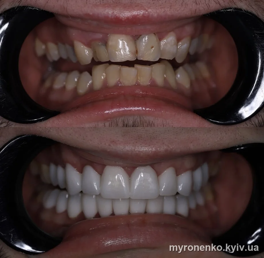 Усмішка до і після лікування — Myronenko Dental Studio