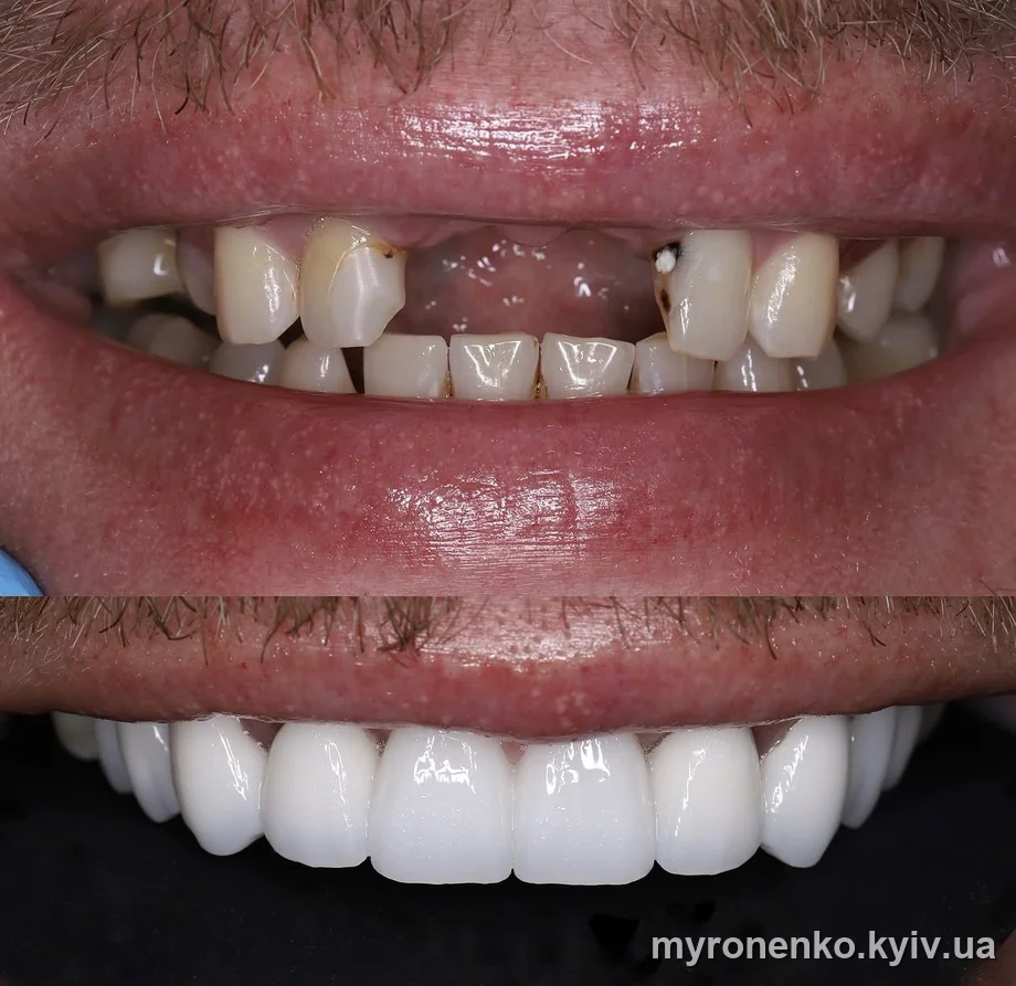 Усмішка до і після лікування — Myronenko Dental Studio