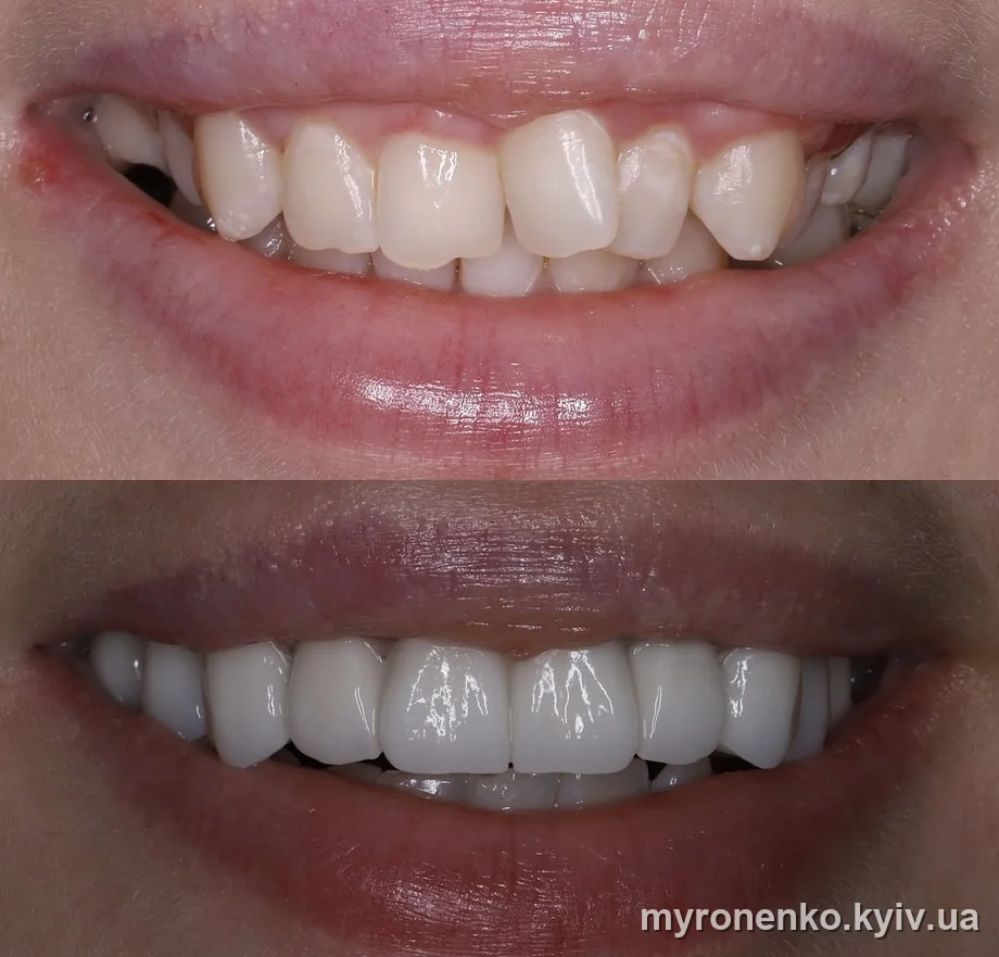 Усмішка до і після лікування — Myronenko Dental Studio