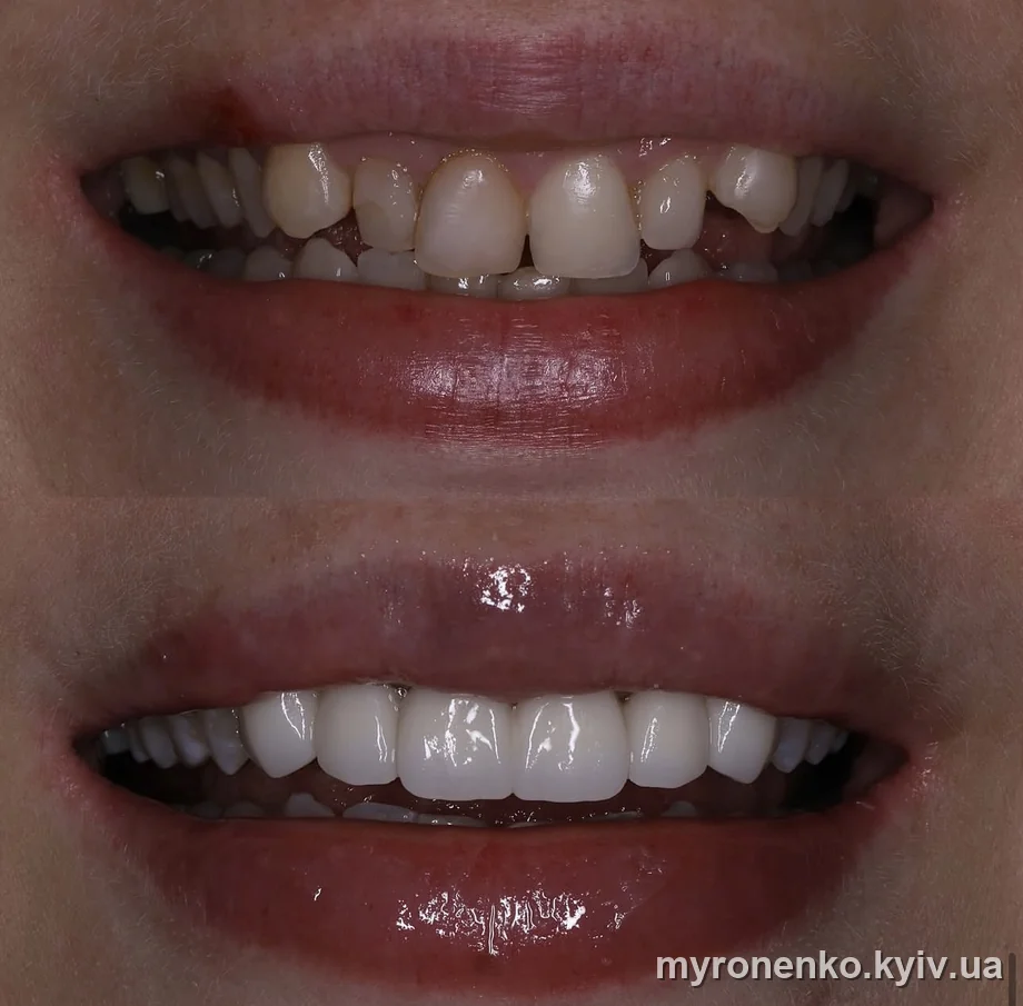 Усмішка до і після лікування — Myronenko Dental Studio