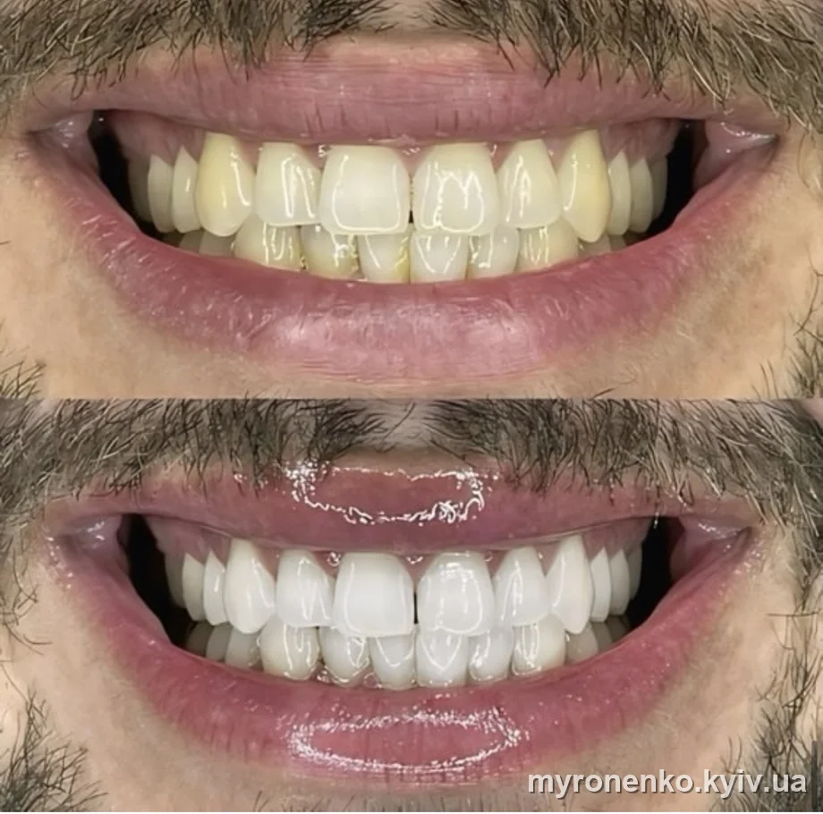 Усмішка до і після лікування — Myronenko Dental Studio